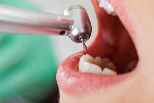 Best Emergency Treatment for Dental Infections or Abscesses in La Vernia, TX